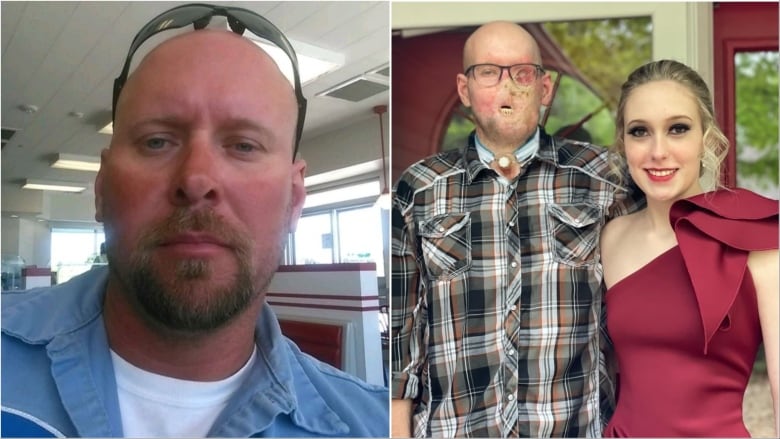 Man who received world's 1st eye and face transplant says it changed his life | CBC Radio