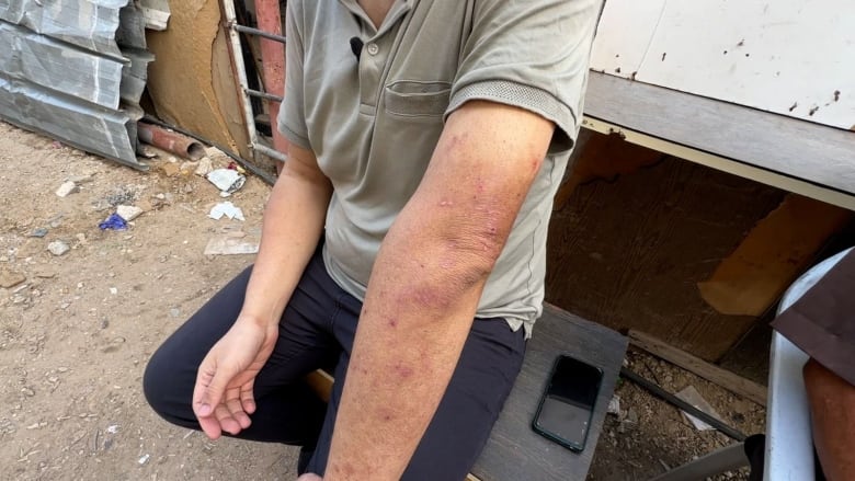 Gaza doctor details accounts of abuse under Israeli custody after being released over 6 months later | CBC News