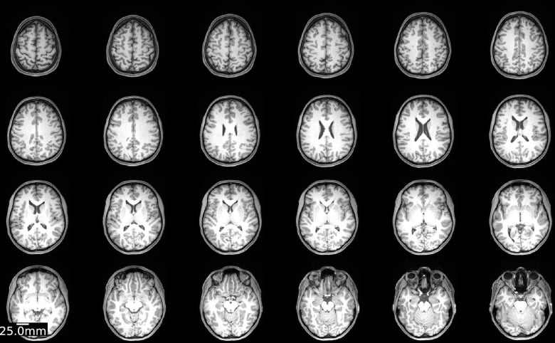 Scientist scans her own brain 75 times to study the effects of birth control pills | CBC Radio
