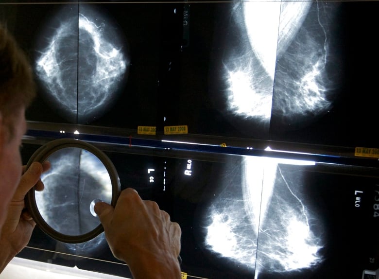 Women falling through the cracks as N.L. lags on breast screening changes, advocate says | CBC News