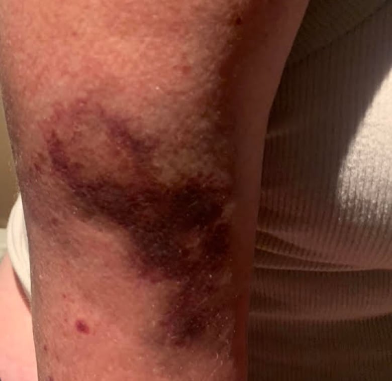 Cancer patient injured after flight, says Air Canada staff failed to properly secure her to wheelchair