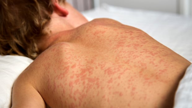 Measles cases nearly double in Ontario over last 2 weeks, far surpassing last decade's total