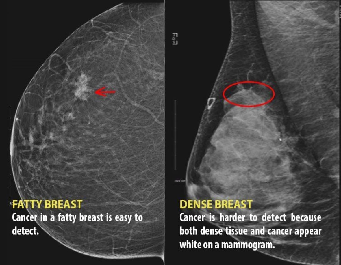 She died of breast cancer. She said it didn't have to be that way