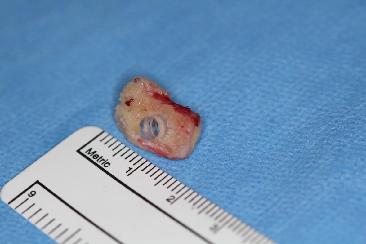 Tooth-in-eye surgery comes to Canada â and itâs exactly what it sounds like
