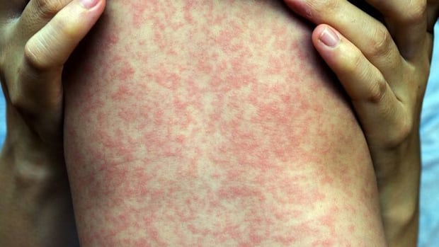 What we know about measles during pregancy following infant's death