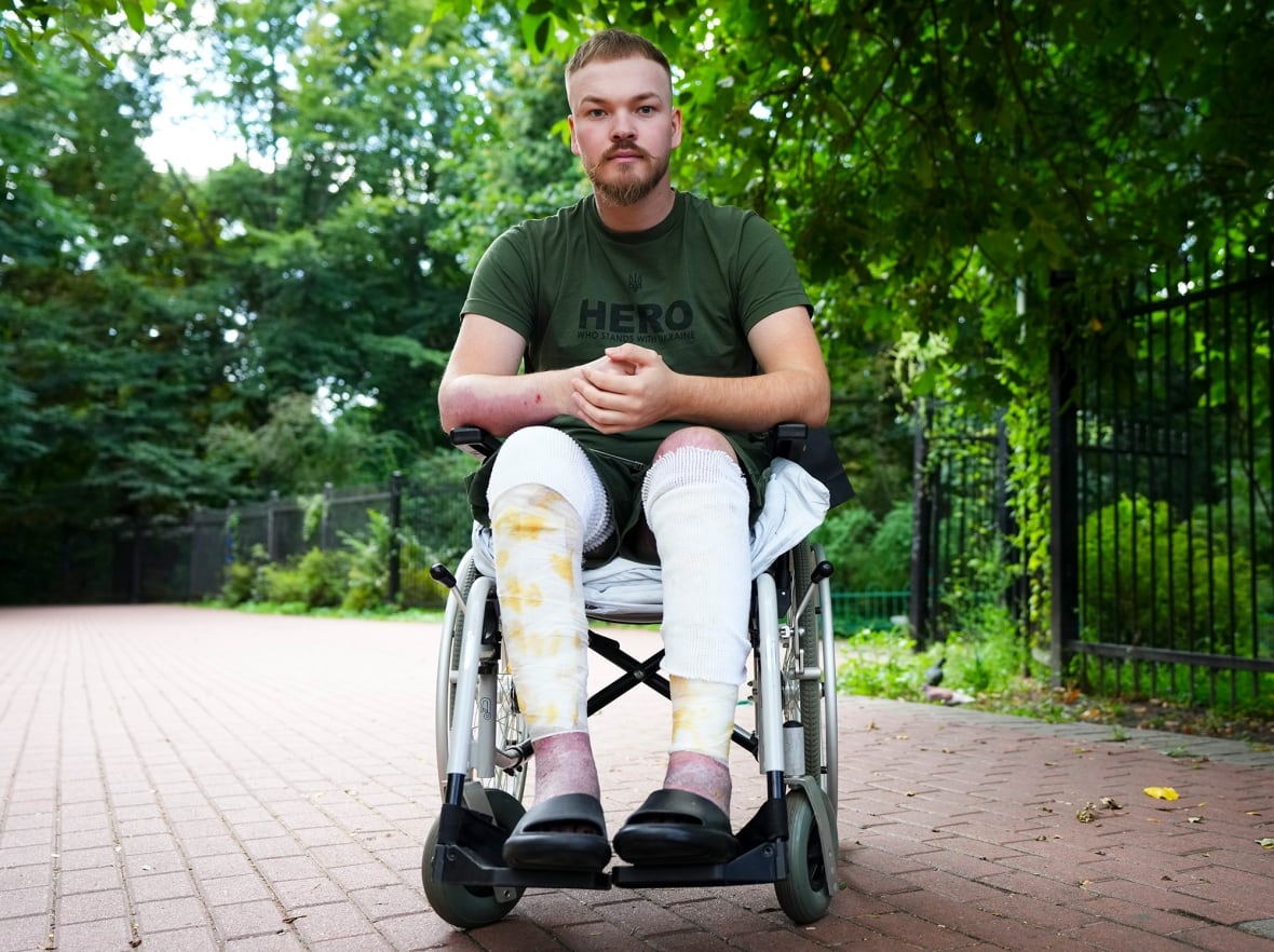 This Calgarian volunteered to fight in Ukraine. He was nearly killed in a drone attack