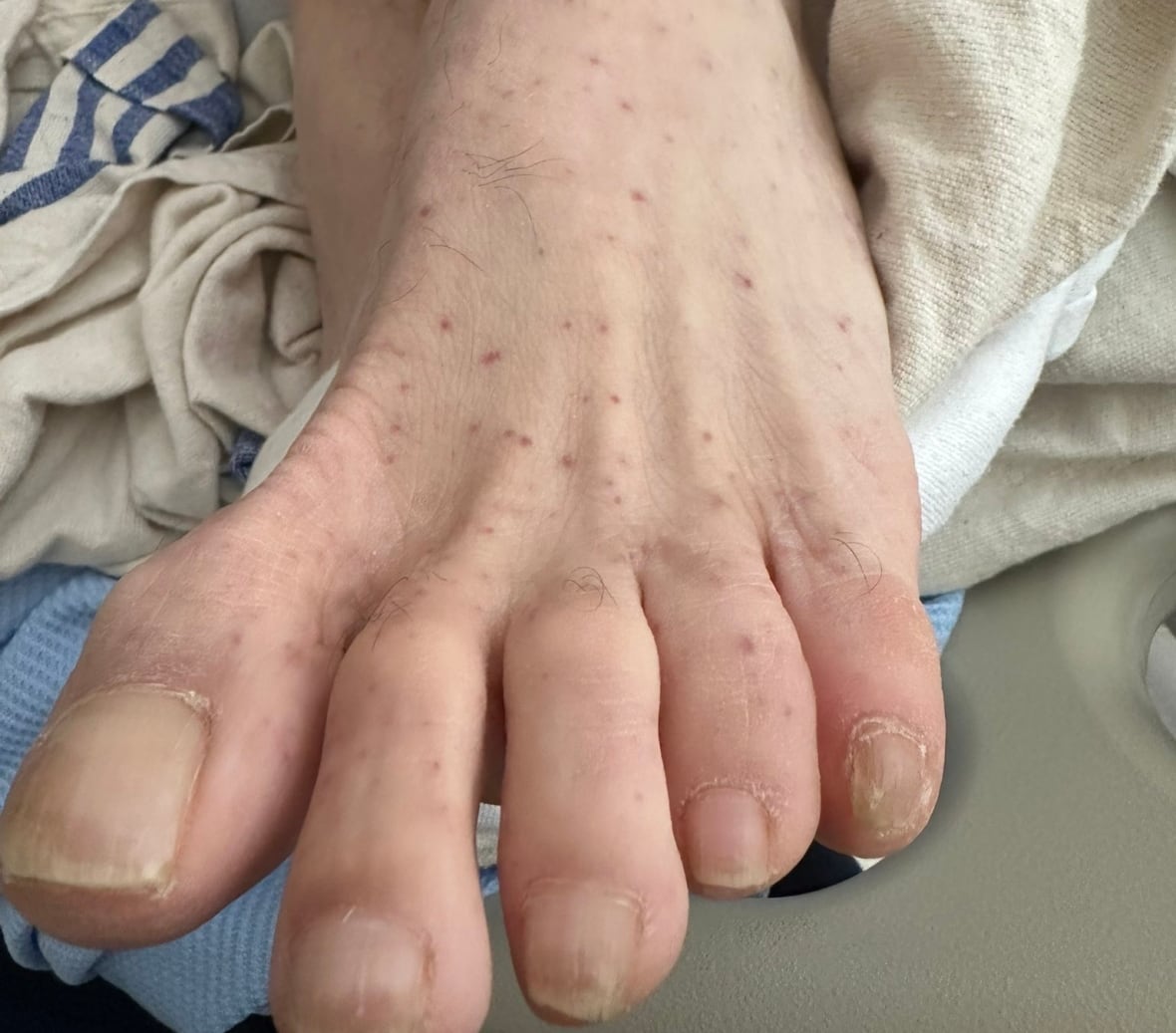 Tick-borne Rocky Mountain spotted fever spreading in Canada