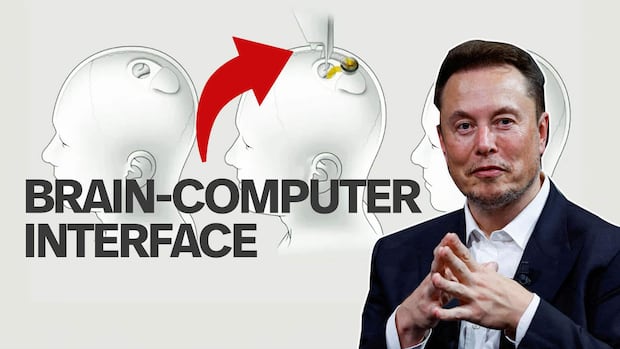 Elon Musk's Neuralink brain chip implanted into 2 quadriplegic Canadian patients as part of clinical trial