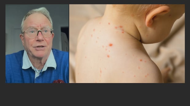 Alberta's role in Canada's loss of measles elimination status embarrassing, former chief medical officer says