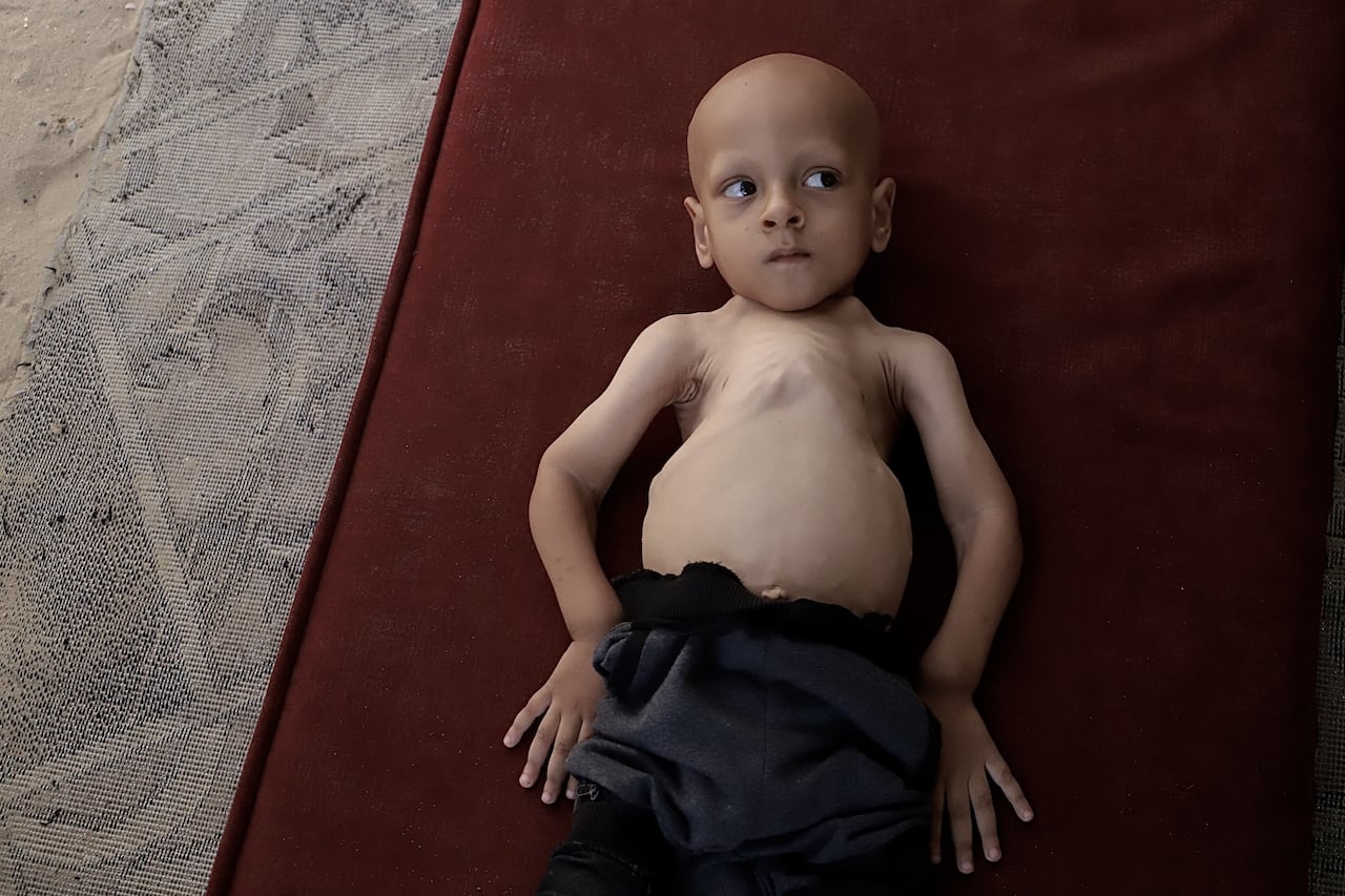 Their 2 kids waited months for medical evacuation from Gaza. 1 died just days after leaving