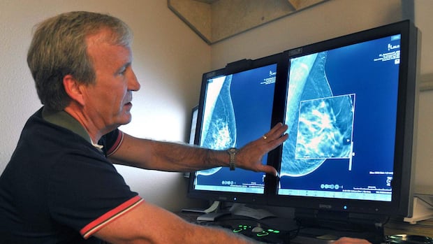 Using AI to read mammograms cut risk of developing aggressive breast cancer, study finds
